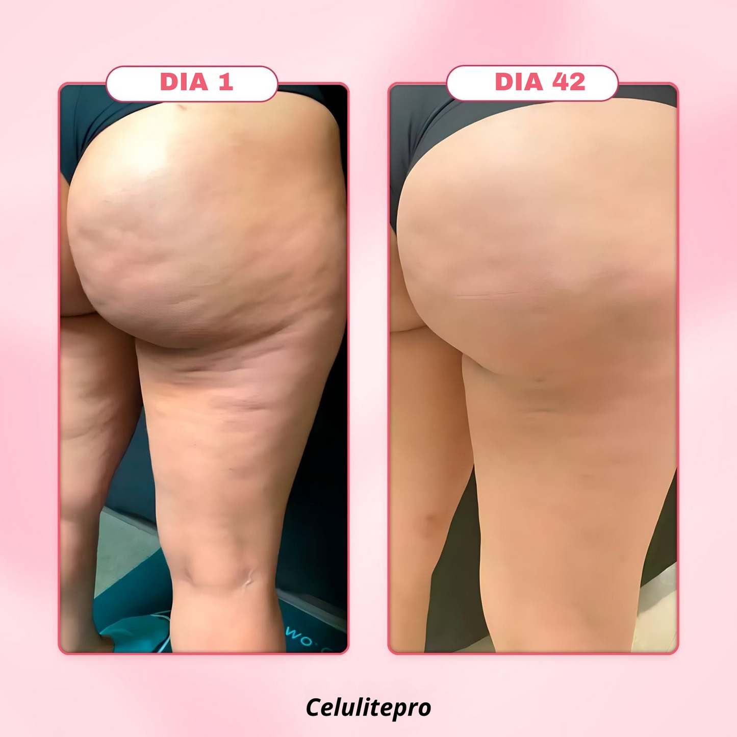 Celulitepro™ - Masajeador anticelulítico